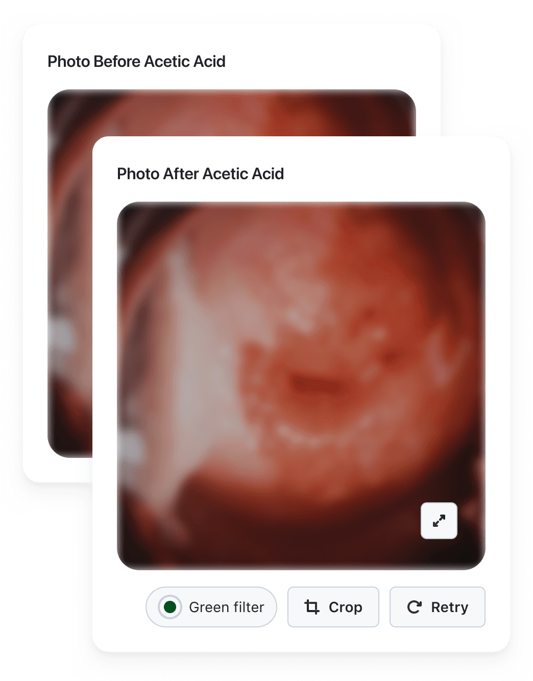 Cervical photos taken before and after acetic acid application, with green filter, crop, and retry options